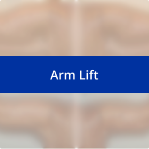 Image for /media/54oh2ynj/arm-lift.png