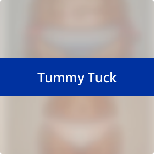 Image for /media/rpepwgpn/tummy-tuck.png