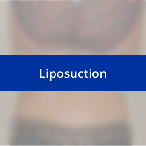 Image for /media/y11i3pif/liposuction.png
